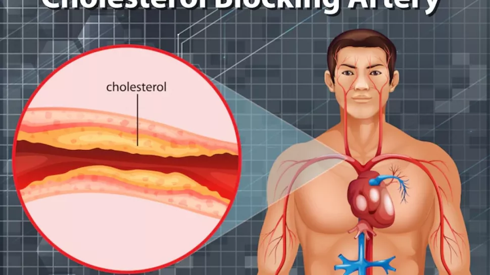 Ilustrasi kolestrol (Freepik)